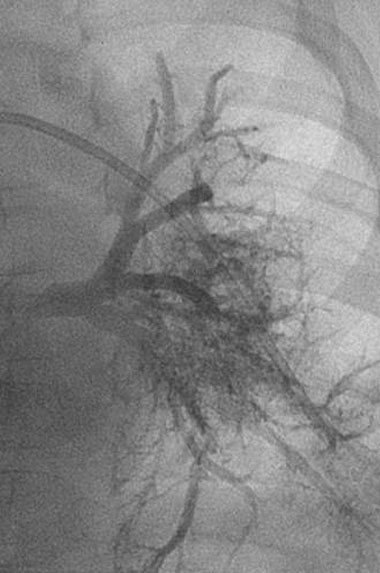 aortic stenosis