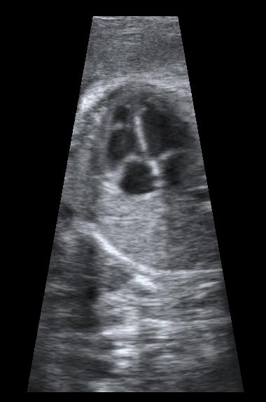 aortic stenosis