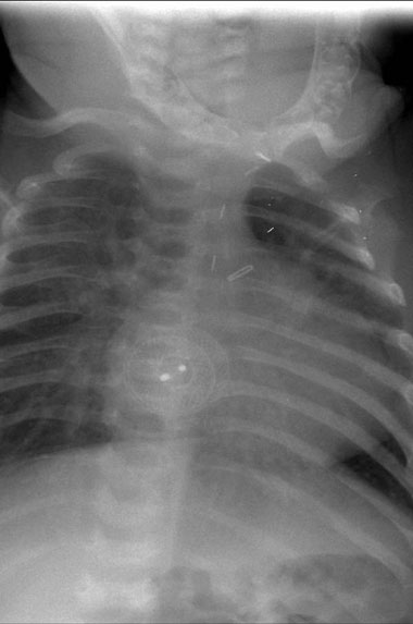 chest x-ray