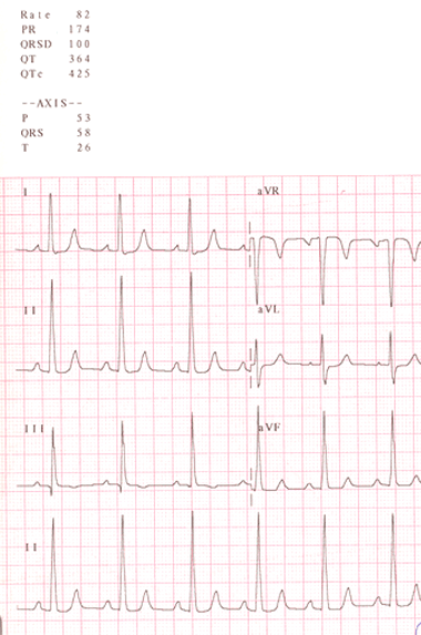 aortic stenosis