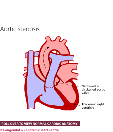 Aortic Stenosis Congenital Children S Heart Centre