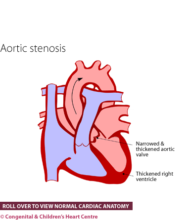 Aortic stenosis