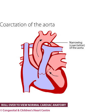 Coarctation of the aorta