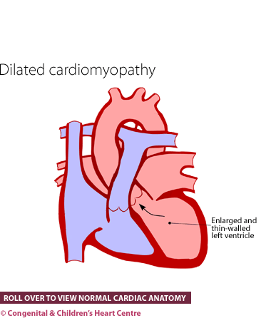 Dilated cardiomyopathy