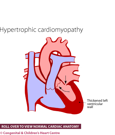 Hypertrophic cardiomyopathy