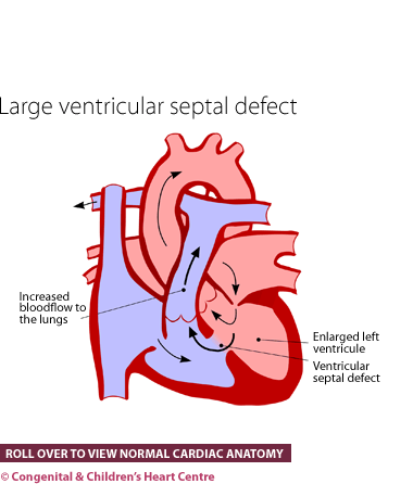 Large ventricular septal defect
