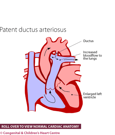 Patent ductus arteriosus