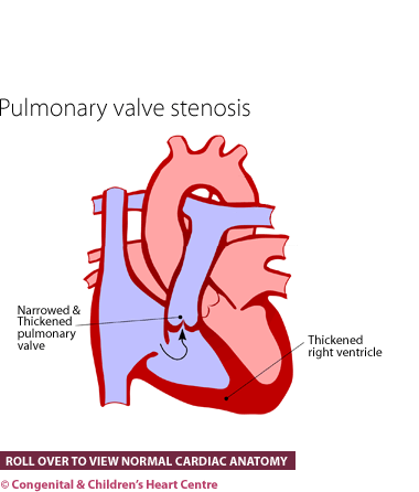 Pulmonary stenosis