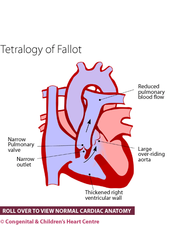 Tetralogy of Fallot