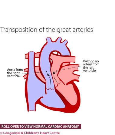 Transposition of the great arteries